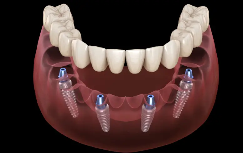 All-on-4® Dental Implants
