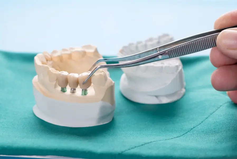 Dental Bridge
