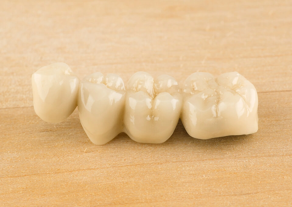 Implant-Supported Crowns