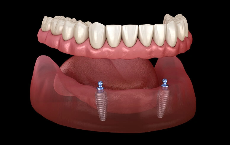 implant-supported-denture-image