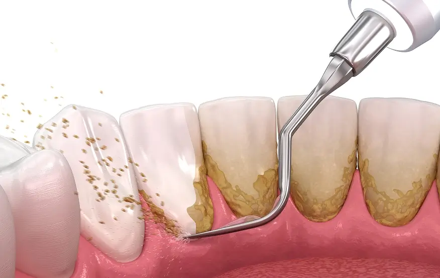 Periodontal Treatment