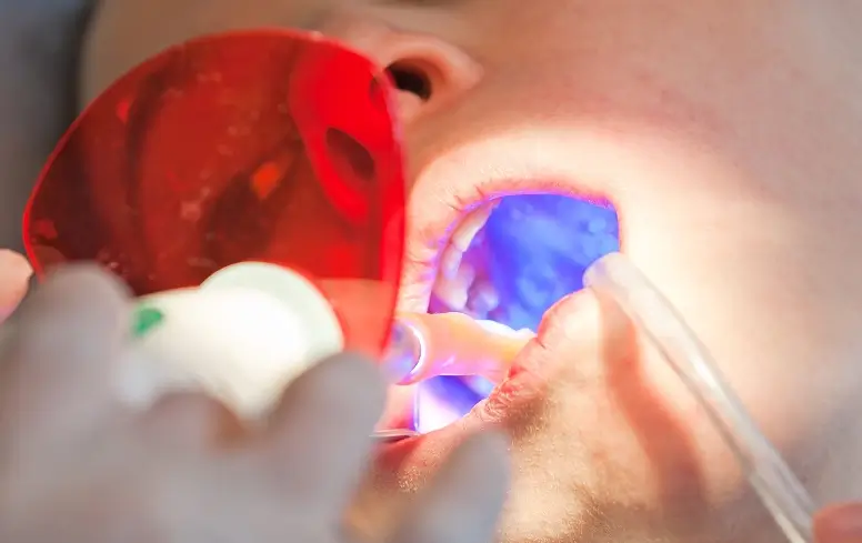 tooth-colored-fillings-image